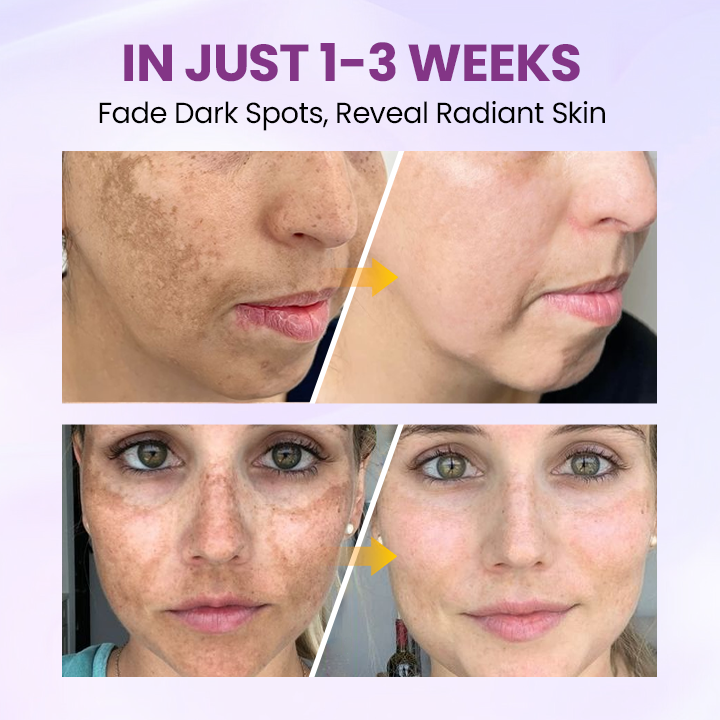 Glowrizon®RadiantClear Blemish & Brightening Serum