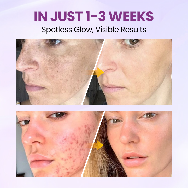 Glowrizon®RadiantClear Blemish & Brightening Serum