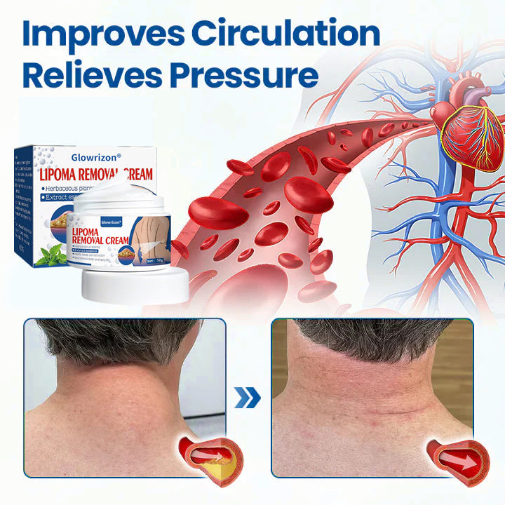 ⏰Last Day Promotion: 70% OFF🔥 Glowrizon® Lipoma Removal Cream