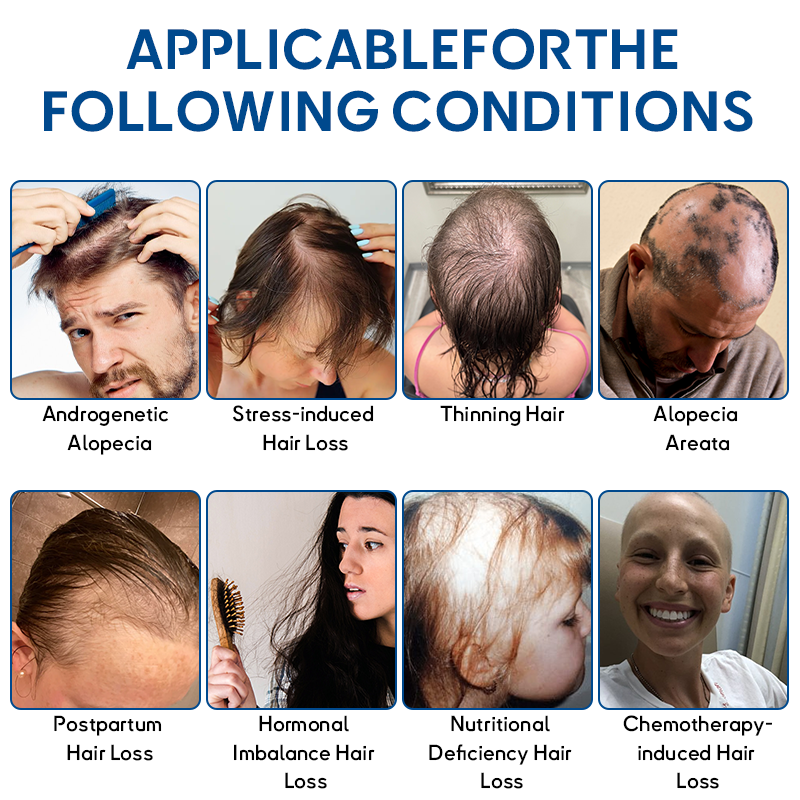 🍁𝐎𝐟𝐟𝐢𝐜𝐢𝐚𝐥 𝐒𝐭𝐨𝐫𝐞 | Flysmus® STEM Cell Hair Cycle Roller - Notice visible results in 7 days (🔥LAST DAY 70% OFF)